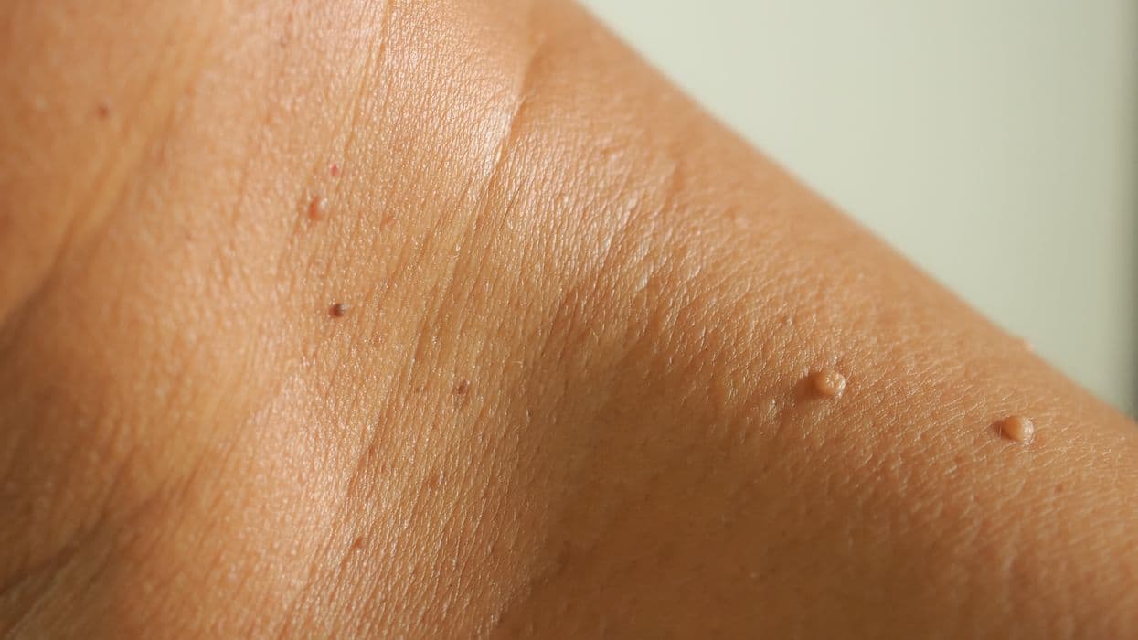 FDA Warns Amazon, Other Vendors About Sale of Skin Tag Removal Products