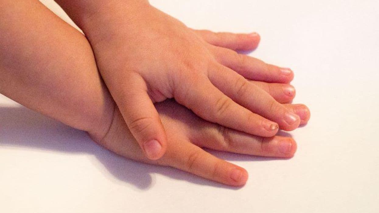 Features of Congenital Nail Matrix Nevi Similar to Adult Subungual Melanoma