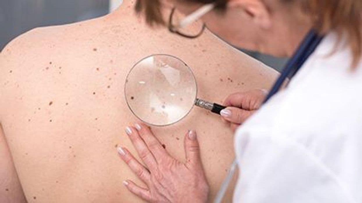 Fewer Cancers Might Be Missed With Full-Body Skin Examinations
