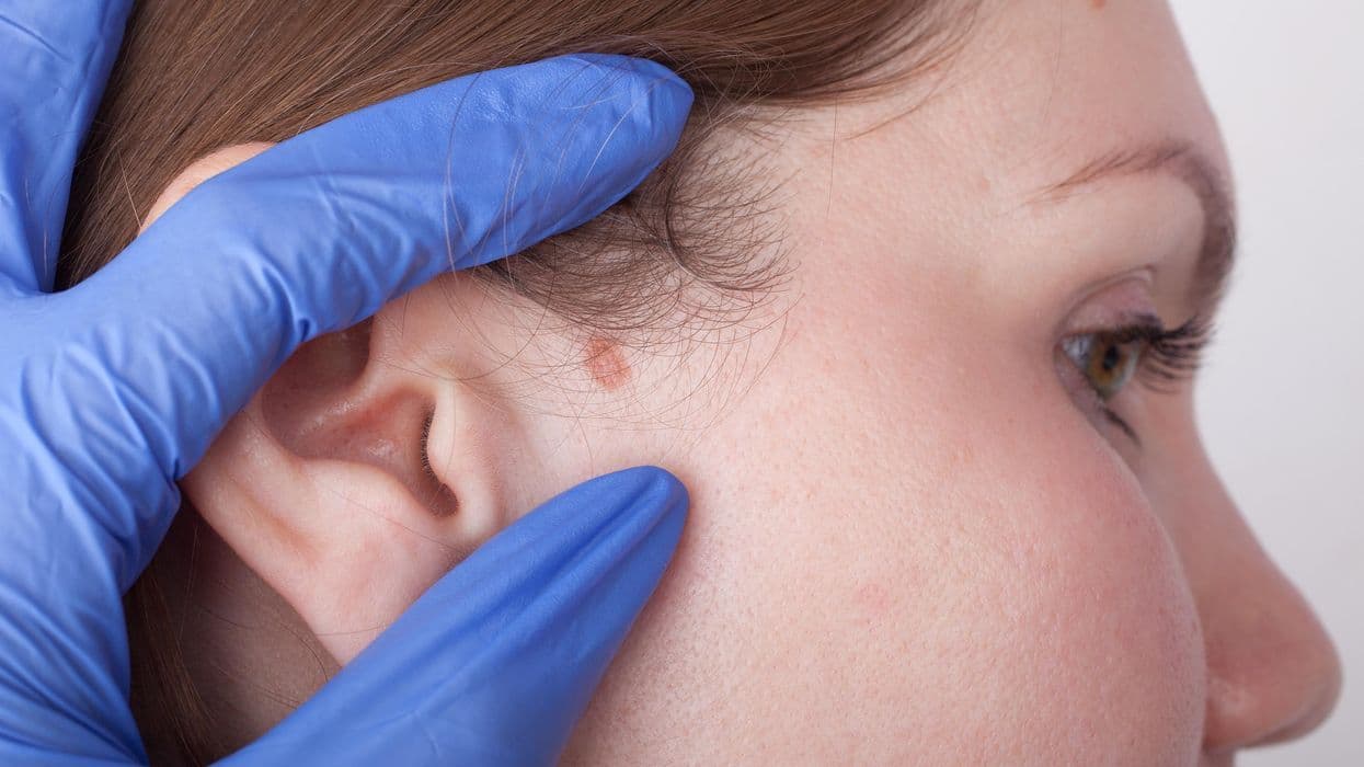 Global Disease Burden Related to Nonmelanoma Skin Cancer Explored