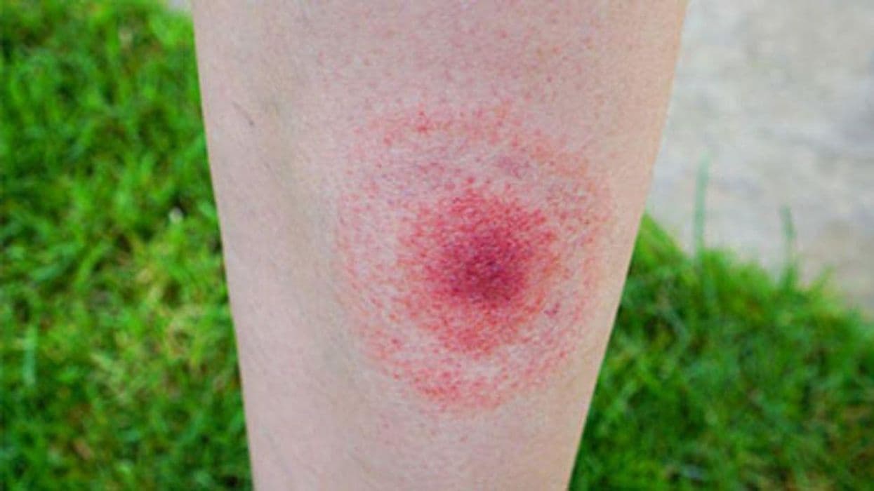 Global Seroprevalence of Tickborne Lyme Disease About 14.5 Percent