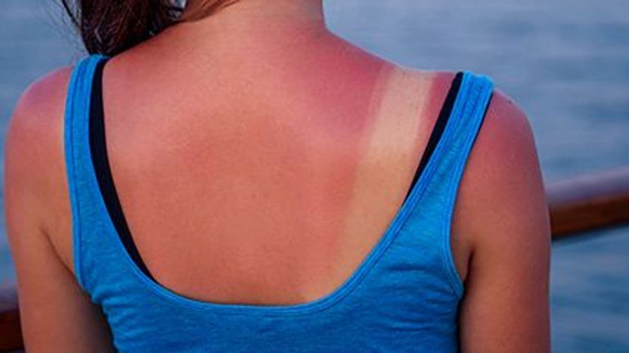 High Sunburn Frequency Through Life Linked to Melanoma, cSCC Risk
