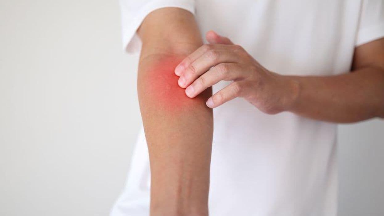 Immediate, Delayed Reactions to Fragrances ID'd in Thai Population