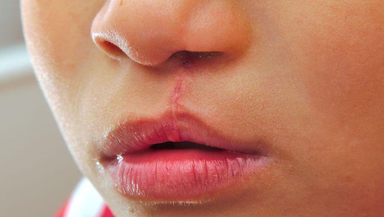Is Botulinum Toxin Type A Effective for Postop Cleft Lip/Palate Scars?