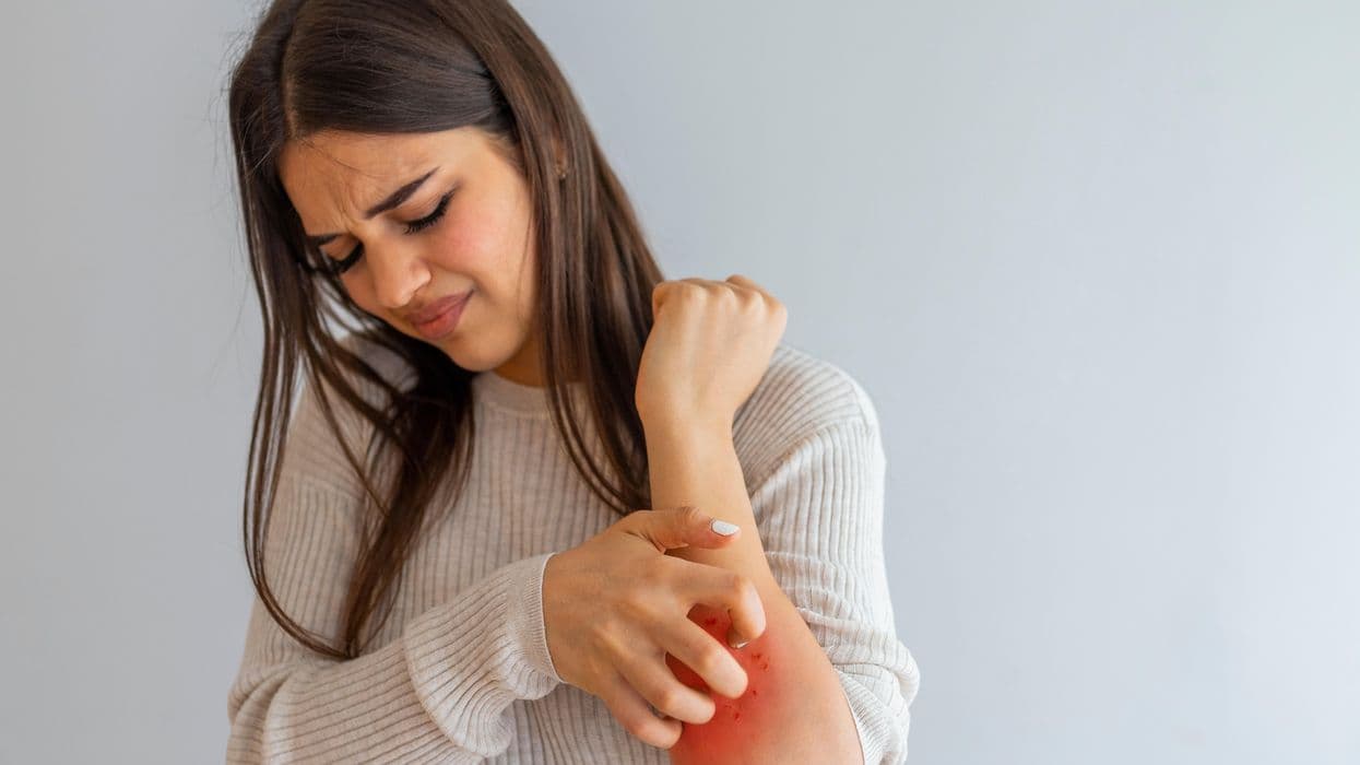 Is Dupilumab Beneficial for Treatment of Erythrodermic Atopic Dermatitis?