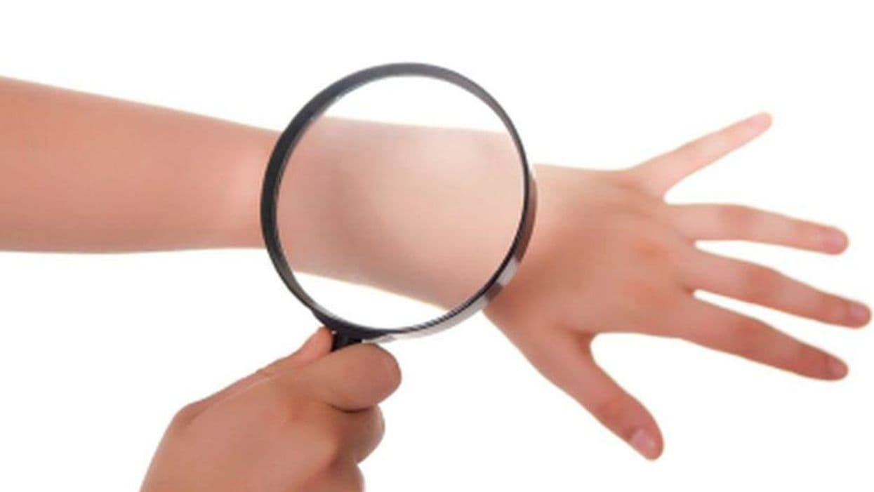 Is Patient-Led Surveillance Feasible After Localized Melanoma?