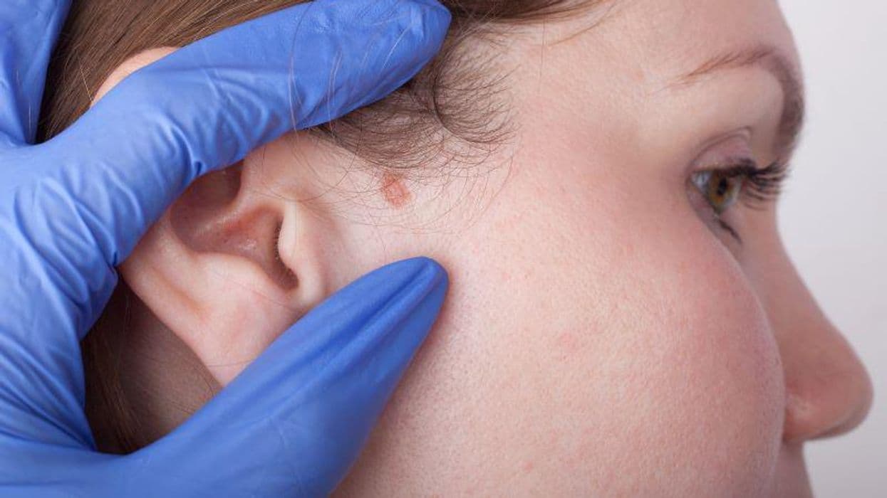 Is Ultrasonography More Sensitive for Detecting Metastases in High-Risk SCC?