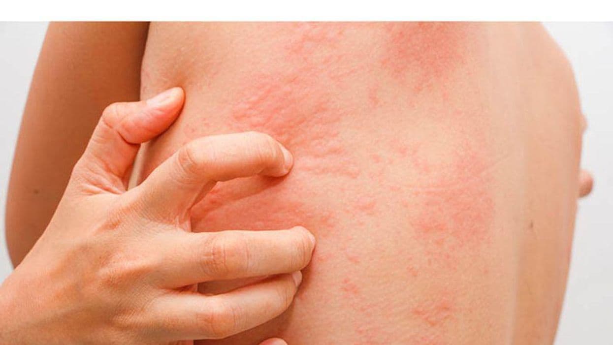 Is Upadacitinib Superior to Dupilumab for Atopic Dermatitis?