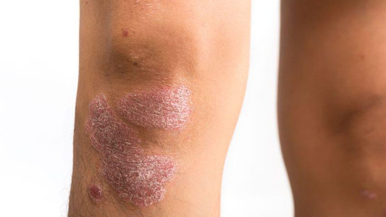 Lifestyle Factors Are Predictive of Incident Psoriasis
