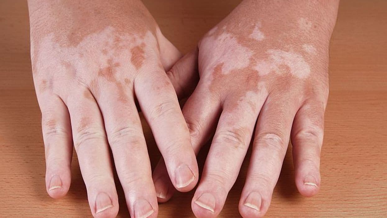 Microneedling, 5FU, Excimer Promising for Nonsegmental Vitiligo