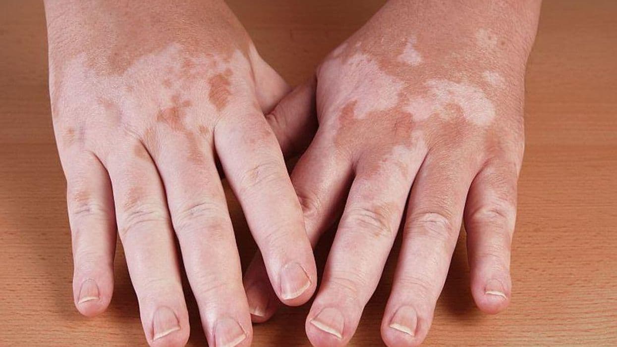 Narrowband UVB, Topical Steroid Combo Superior for Vitiligo