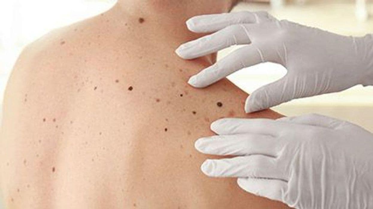 Nevi, Genetic Predisposition More Strongly Linked to Second Melanoma
