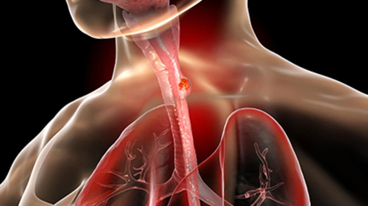 Nivolumab Combo Treats Advanced Esophageal Squamous-Cell Carcinoma