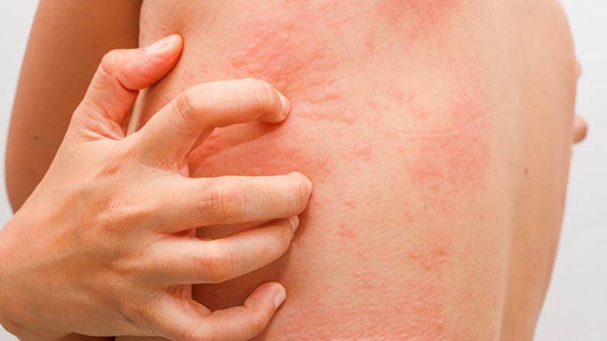 Patients With Inflammatory Skin Diseases Have High Stress Scores