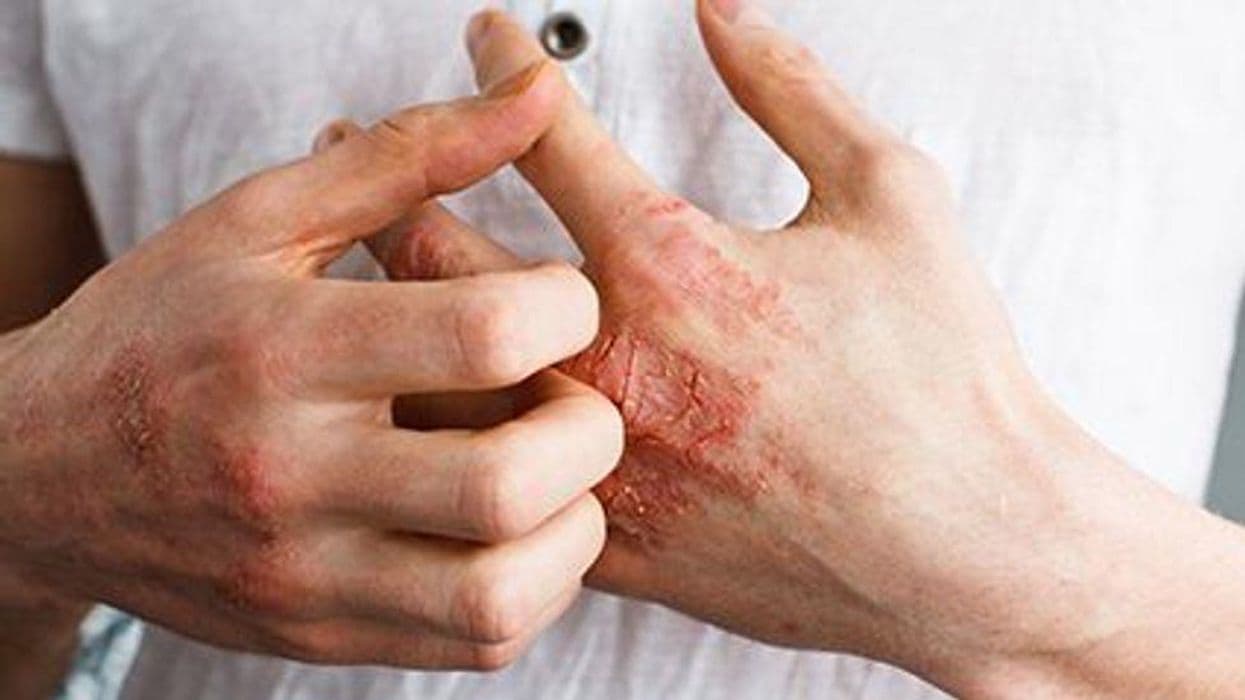 Personal Care Product-Related Contact Dermatitis Increasing