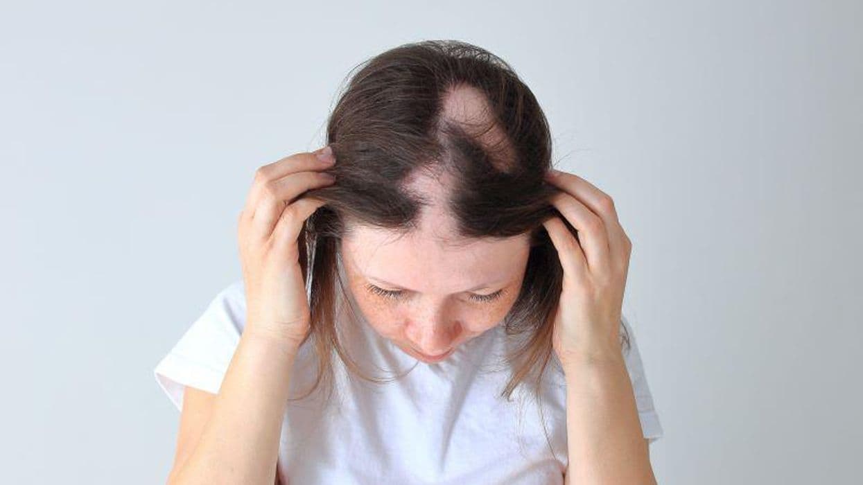 Prevalence of Alopecia Areata Increased From 2016 to 2019 in the United States