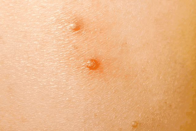 Intralesional Immunotherapy Promising for Molluscum Contagiosum