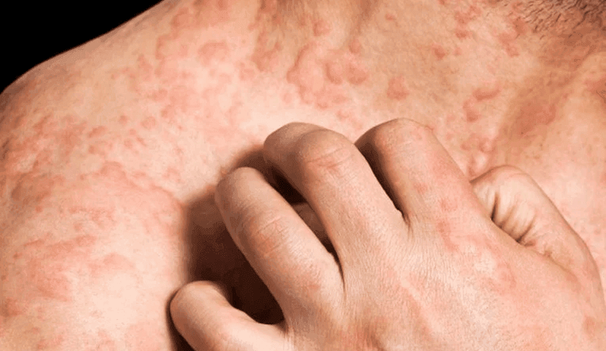 Lymphoid Reaction Observed in Eczema Patients Receiving Dupilumab