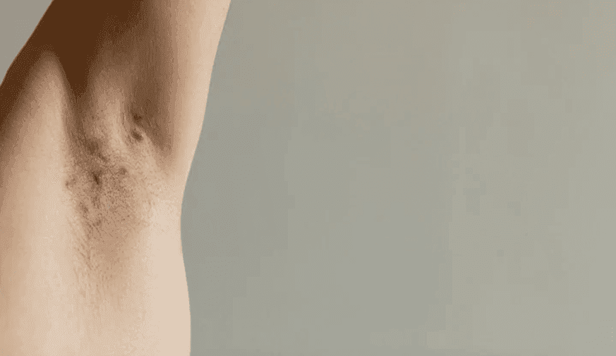 Clinical Markers Improve With IV Ertapenem for Hidradenitis Suppurativa