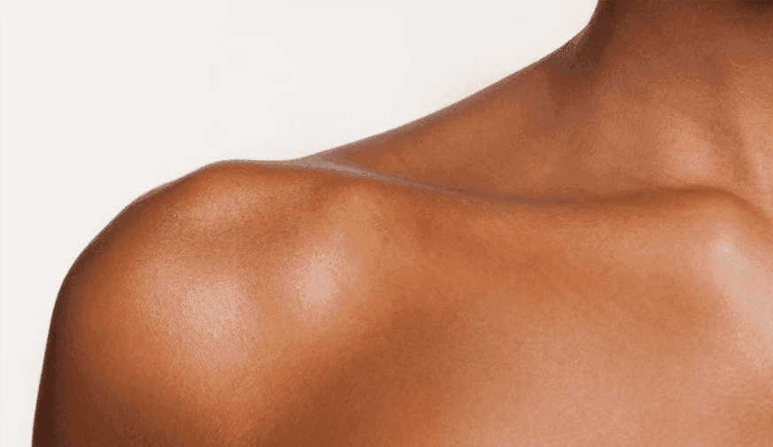 Skin of Color Underrepresented in AI Programs in Dermatology