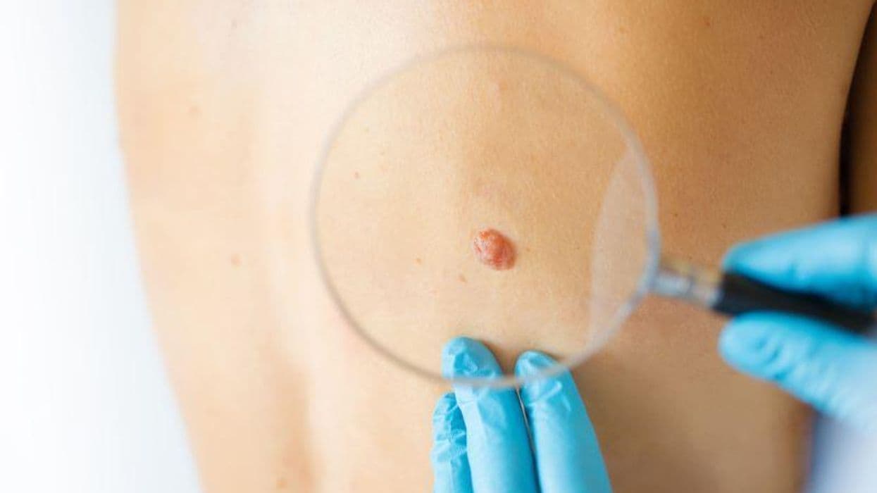 Characteristics Differ for Melanomas in Children, Teens, Young Adults