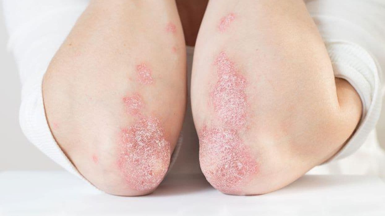Roflumilast Yields Better Results for Chronic Plaque Psoriasis