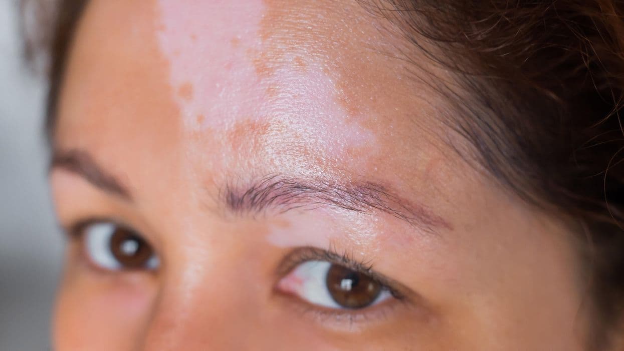 Ruxolitinib Cream Results in Greater Repigmentation in Vitiligo