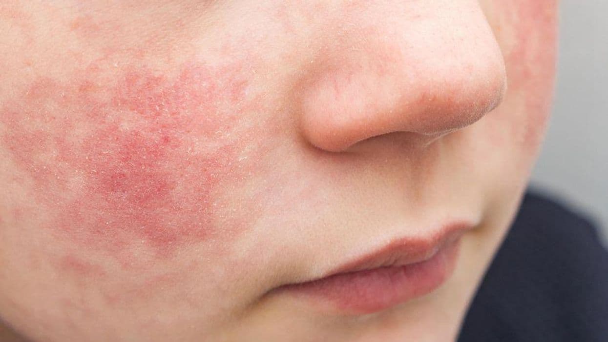 Severe Eczema Tied to Depression, Internalizing Behaviors in Children