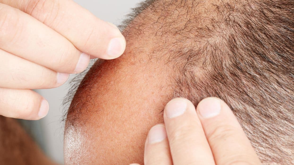 Side Effect and Life-Long Use Concerns Are Barriers to Minoxidil Use