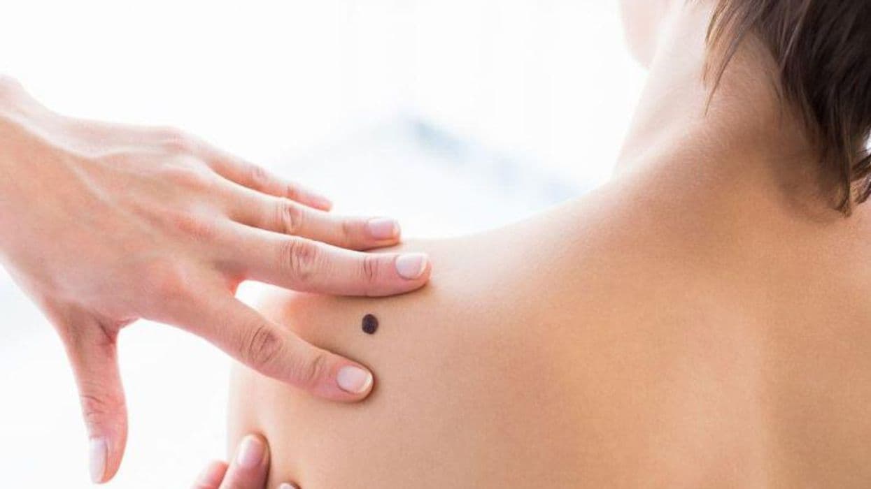 Study Aims to Identify Melanoma Patients With High-Risk Disease
