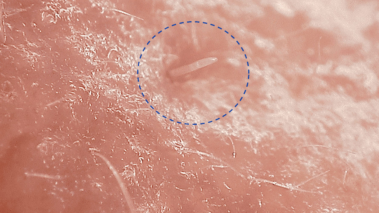 Tiny Mites Are Feeding on Your Skin, But for How Long?