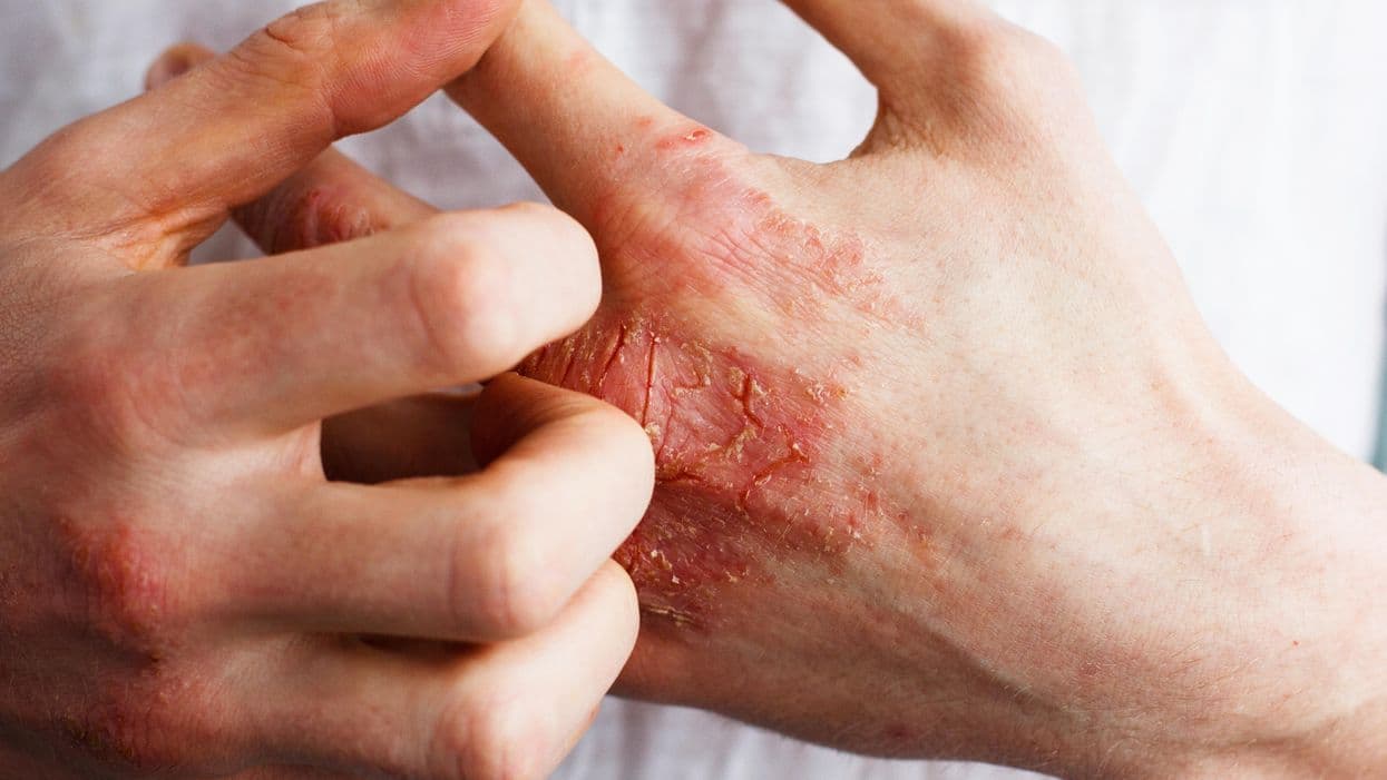 Two Years of Tralokinumab Safe, Efficacious for Atopic Dermatitis