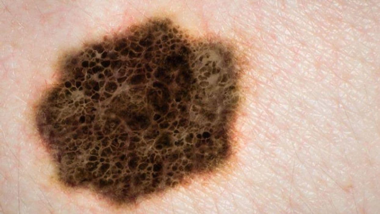 Update Shows Relatlimab Nivolumab Slows Advanced Melanoma