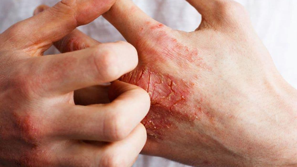 What Are the Most Common Occupationally Related Allergens?