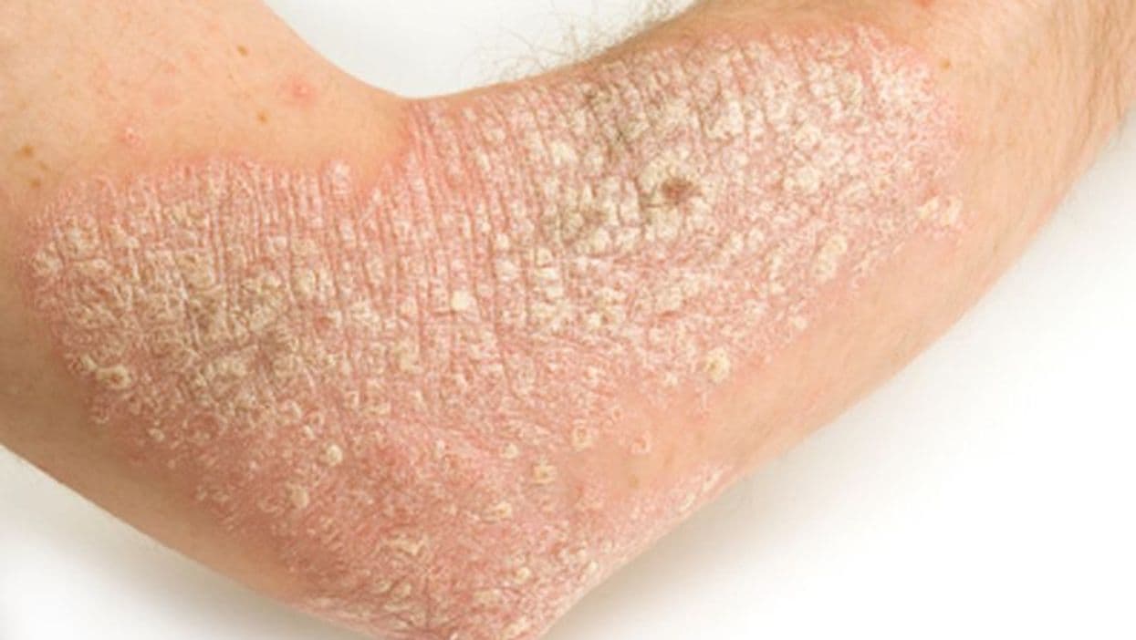 What Factors Impact Treatment Outcomes in Psoriasis?