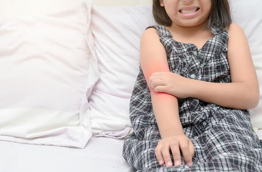 FDA Approves Opzelura for Atopic Dermatitis in Children