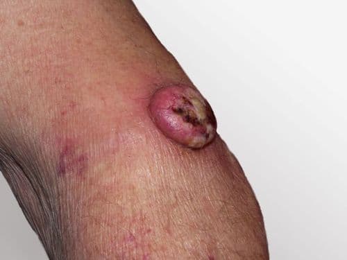 'HowTo’ Choose: PD-1 and PD-L1 Inhibitors in Advanced Cutaneous Squamous Cell Carcinoma: Microlearning CME Activity