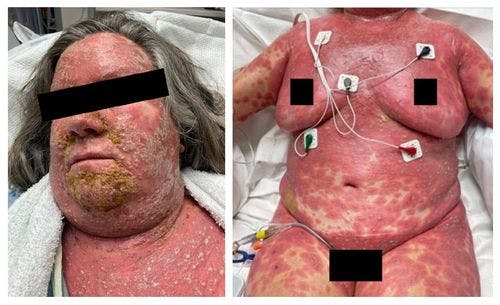 A Life-Saving Treatment in a 60-year Old Patient With Rapid Eruption of Pustules