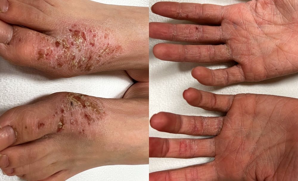 Effective Primary Management of an Exacerbation of Atopic Dermatitis Using a Non-Steroidal Topical Therapy
