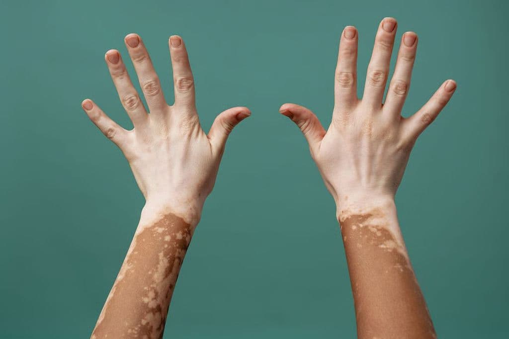 Povorcitinib Leads to Substantial Repigmentation in Nonsegmental Vitiligo